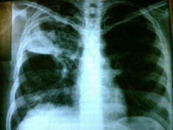  Hình ảnh tổn thương phổi do lao trên phim Xquang.