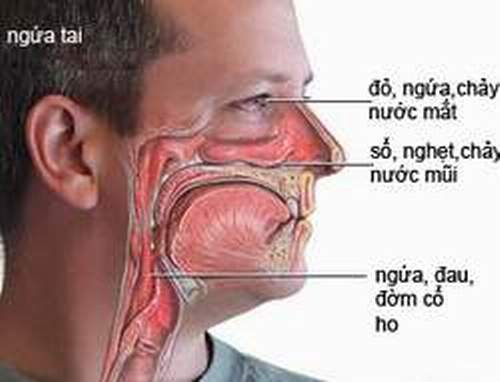  Viêm mũi dị ứng - bệnh hay tái phát và phải dùng phối hợp  nhiều loại thuốc để điều trị bệnh