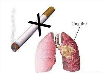 Hút thuốc lá là nguyên nhân hàng đầu gây  ung thư phổi.