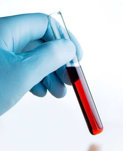 Ung thư buồng trứng có thể được phát hiện sớm bằng cách xét nghiệm máu - Ảnh: Shutterstock