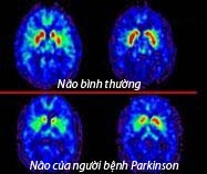   Hình ảnh não người bình thường và của người bệnh Parkinson.