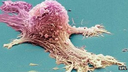 Ung thư buồng trứng là loại ung thư phổ biến và đứng thứ 5 ở phụ nữ Anh.