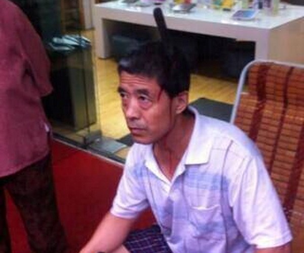  Ông Xiao bị dao cắm vào đầu. (Nguồn: CCTV)