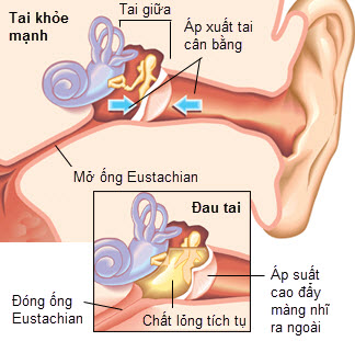 Hình ảnh tai bình thường và đau tai do viêm.
