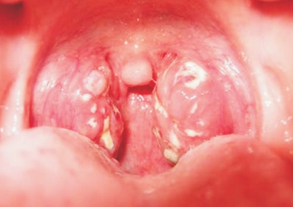 Màng giả ở họng là dấu hiệu đặc thù của bệnh bạch hầu