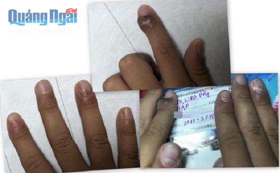 Các đầu ngón tay của một đứa trẻ ở Tây Ninh bị lở sau khi chơi 