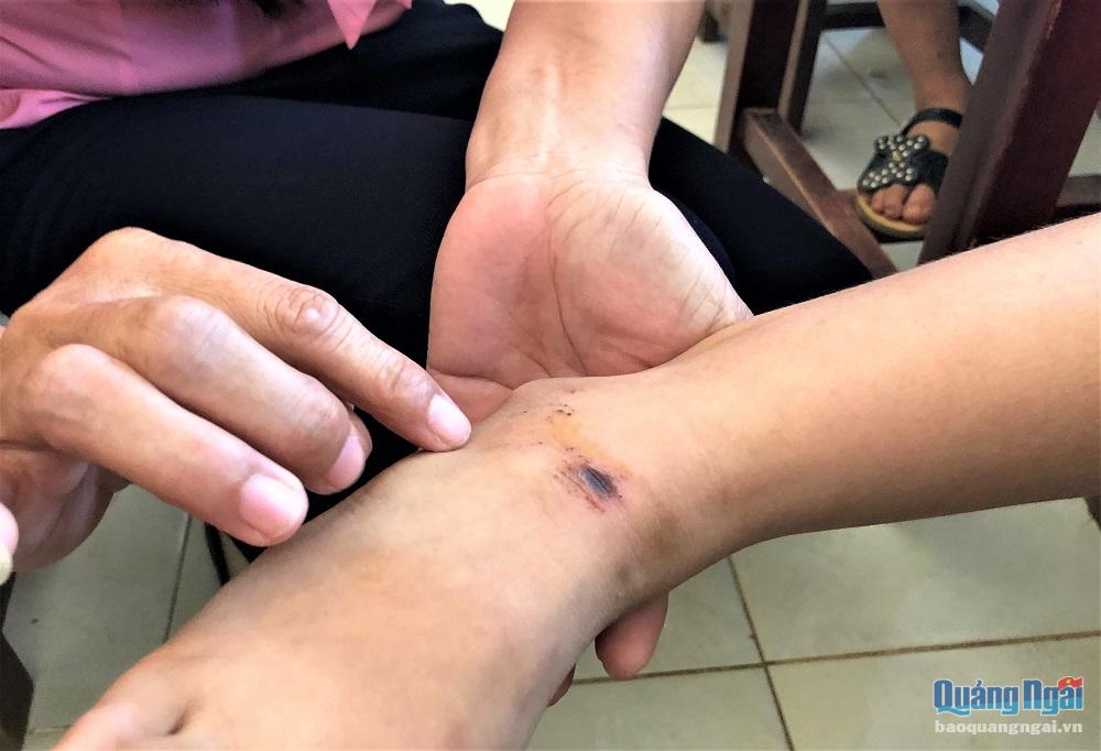 Trong số 6 học sinh bị chó cắn, có 3 em được đưa đi tiêm huyết thanh ở Đà Nẵng vì bị cắn ở vùng nguy hiểm, tập trung các dây thần kinh trung ương