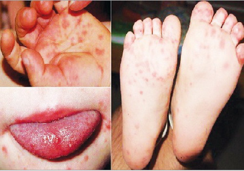  Bệnh TCM thường gặp ở trẻ nhỏ với biểu hiện là các mụn nước ở họng, hầu, tay, chân...