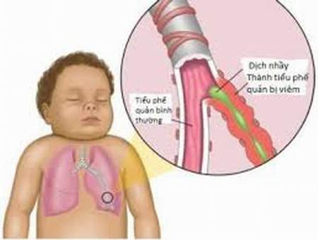  Hình ảnh viêm tiểu phế quản ở trẻ.
