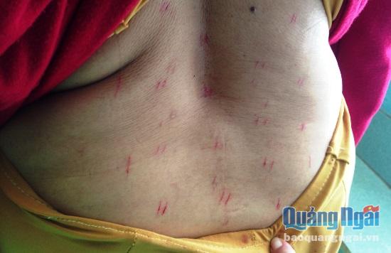 Hàng chục vết rạch do dao lam trên lưng một bệnh nhân đến xin chữa thoát vị đĩa đệm tại cơ sở của ông Nguyễn Văn Phương