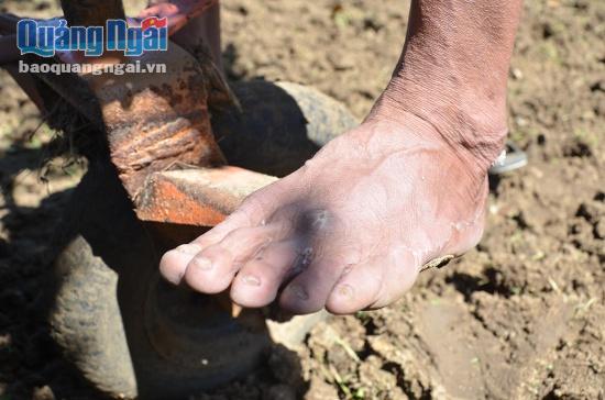 Đôi bàn chân của một chủ máy cày sau 20 năm lội ruộng ngấm thuốc diệt cỏ. Ảnh: Phạm Linh.
