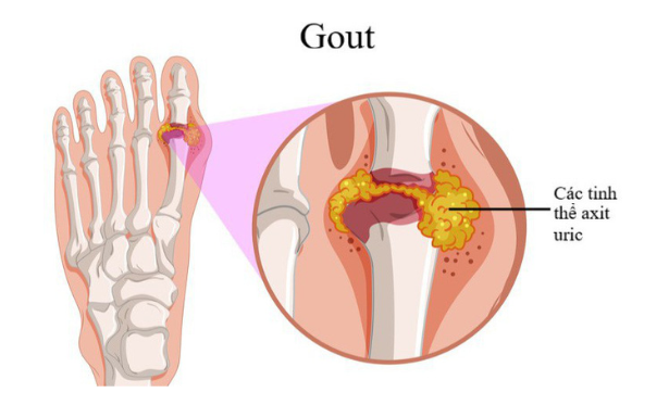 Trong bệnh gout, các tinh thể axit uric tích tụ trong các khớp gây ra sưng, viêm và đau dữ dội.