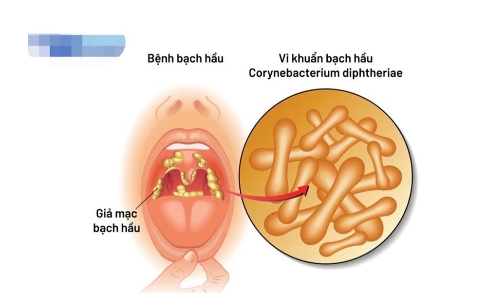 Cần lưu ý điểm gì khi trẻ mắc bệnh bạch hầu