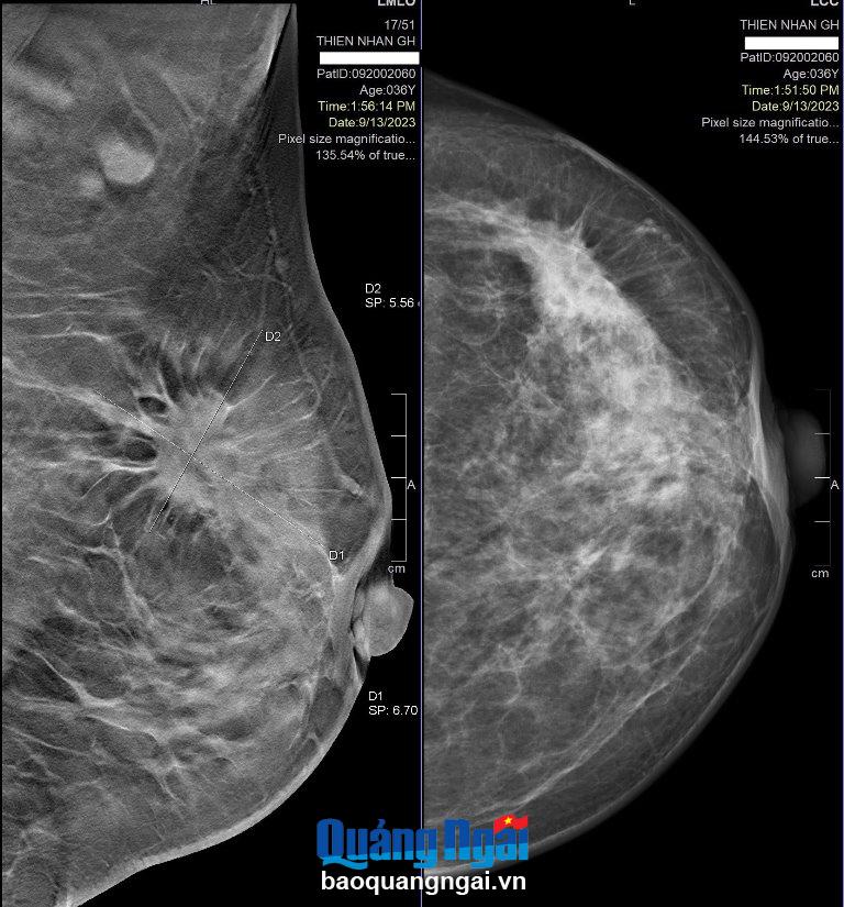 Kết quả chụp nhũ ảnh 3D phát hiện khối u ác tính ở vú trái của một bệnh nhân trẻ tuổi.