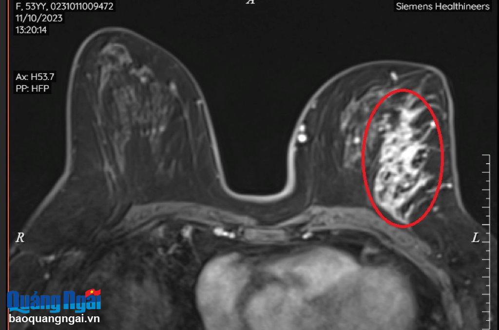Hình ảnh chụp MRI cho thấy có tổn thương không tạo khối nằm ở vú trái của bệnh nhân.