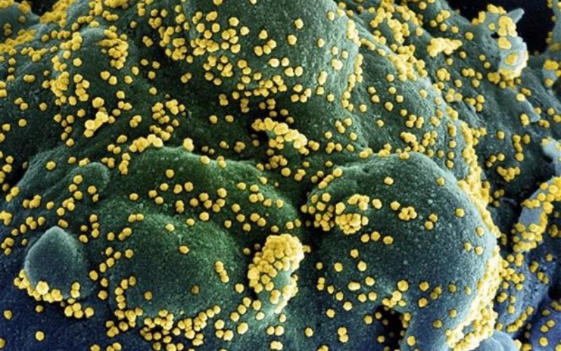 Một tế bào (xanh dương/xanh lục) bị nhiễm nặng các hạt virus SARS-CoV-2 (màu vàng), được phân lập từ mẫu của bệnh nhân Covid-19. Ảnh: AFP