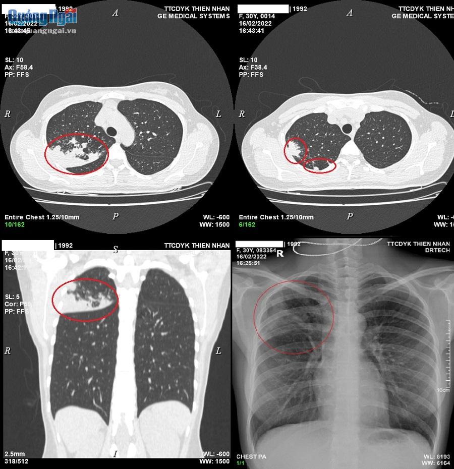 Tổn thương đông đặc nhu mô phổi phải trên hình ảnh cắt lớp vi tính và X-quang của bệnh nhân T.U.