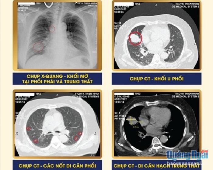 Hình ảnh X-quang và CT của bệnh nhân cho thấy rõ 2 khối u phổi.