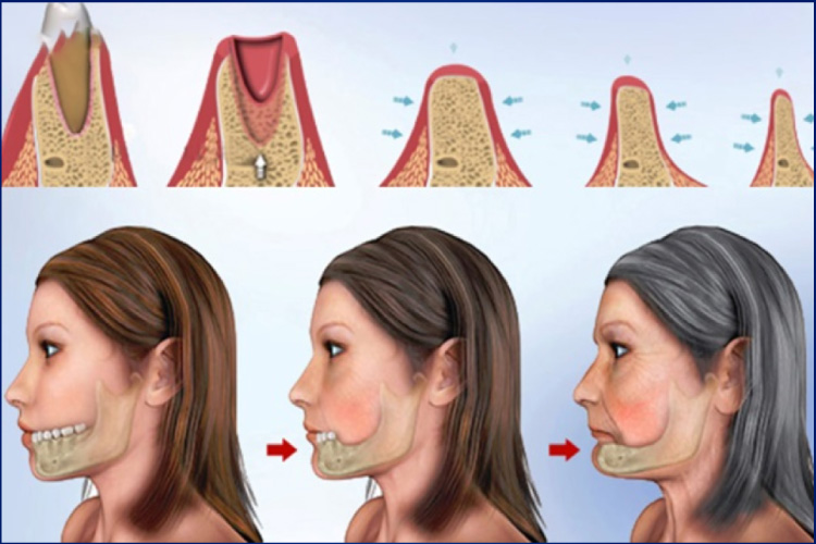 Quá trình tiêu xương hàm sau khi mất răng