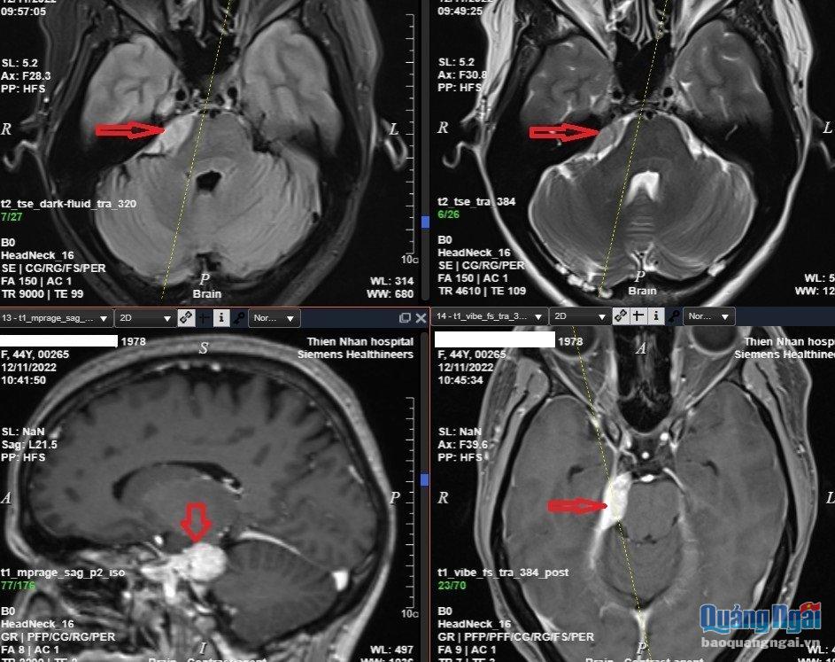 Hình ảnh chụp MRI não có tiêm thuốc đối quang từ của chị N cho thấy rõ u màng não.