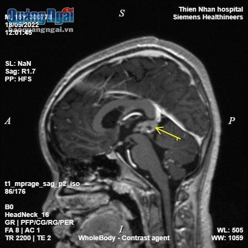 Hình ảnh chụp MRI toàn thân của bệnh nhi cho thấy u tế bào mầm di căn tuyến tùng.