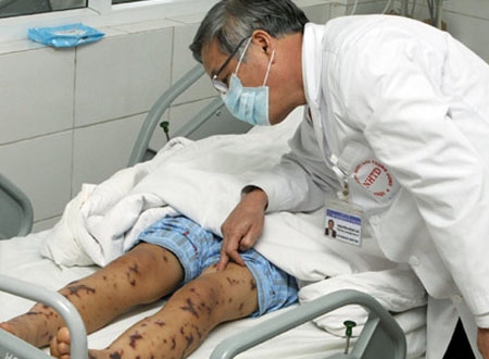 Hình ảnh bệnh nhân bị nhiễm liên cầu khuẩn do ăn tiết canh lợn.